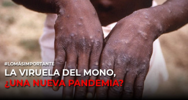 La viruela del mono, ¿una nueva pandemia?